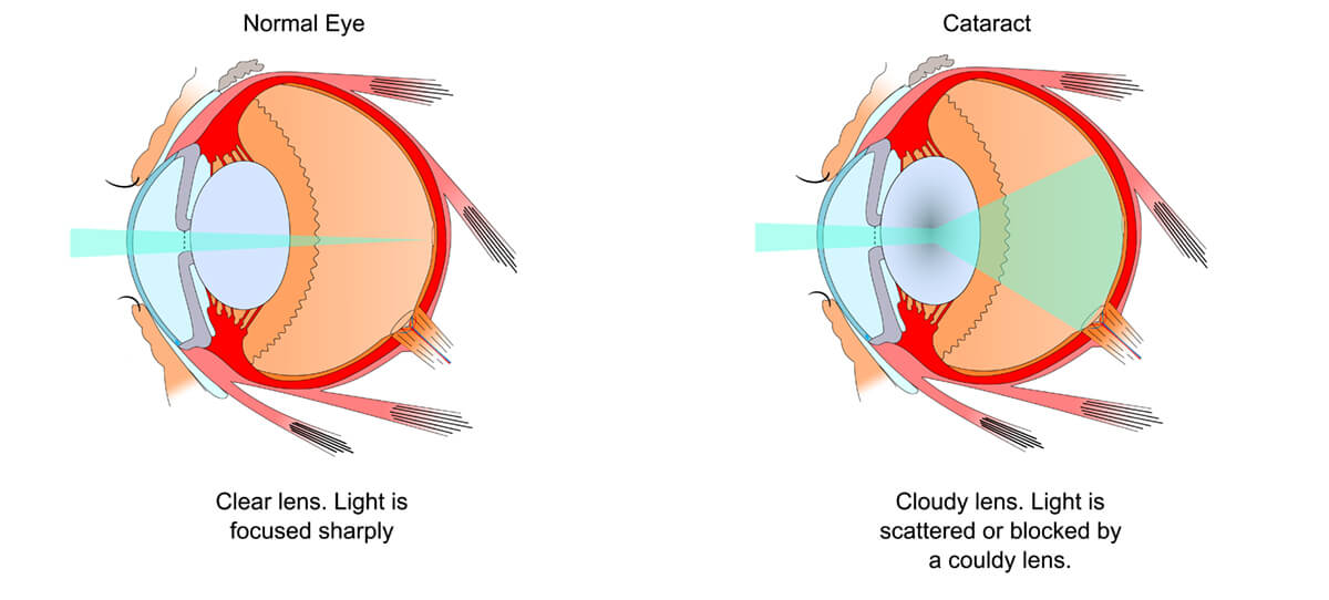 Нормальный глаз схема. Катаракта схема глаза. Патология хрусталика (катаракта). Катаракта глаза катаракта схема. Схема хрусталика глаза.