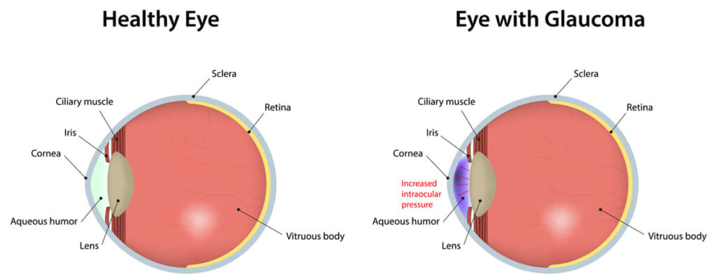 Glaucoma Diagram - Healthy Eye vs Eye with Glaucoma
